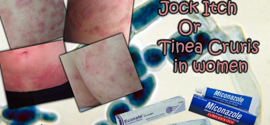 Jock itch or Tinea cruris in women