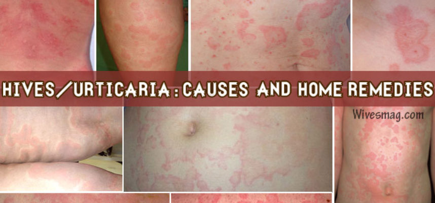 Causes and best Home remedies for Urticaria or Hives