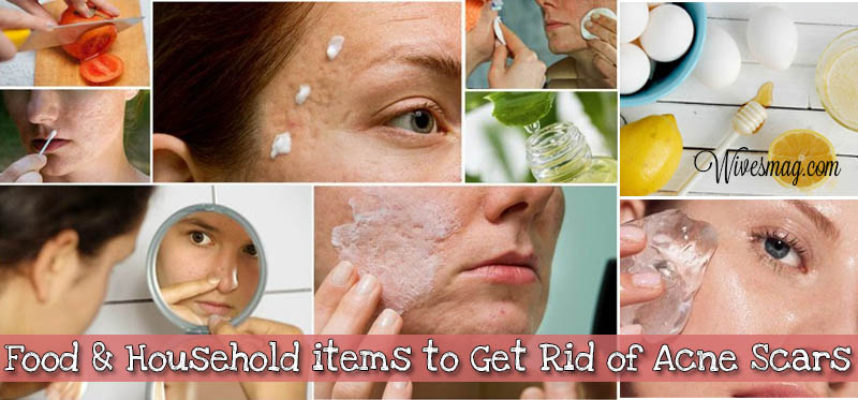 acne scars home remedies