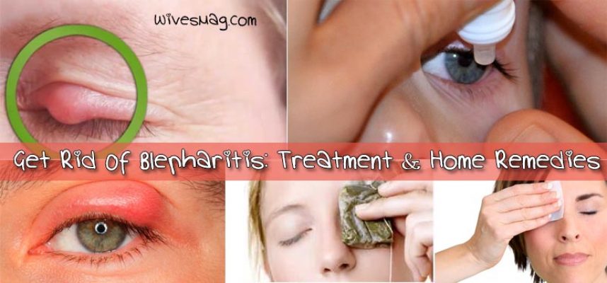 get rid of blepharitis Home Remedies