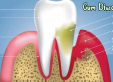 everything-to-know-about-gum-disease