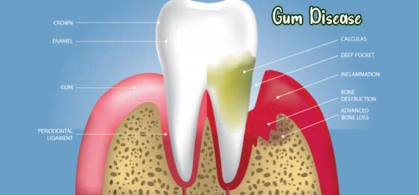 everything-to-know-about-gum-disease