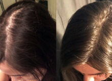 before and after hair regrow comparison